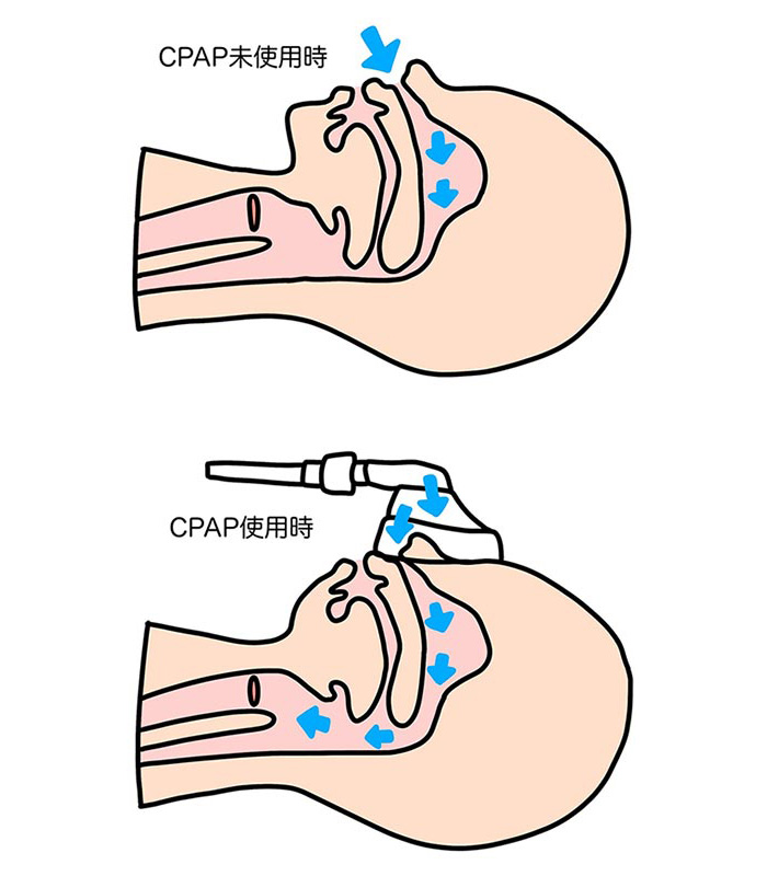 CPAP療法イメージ