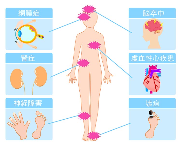 糖尿病の症状イメージ