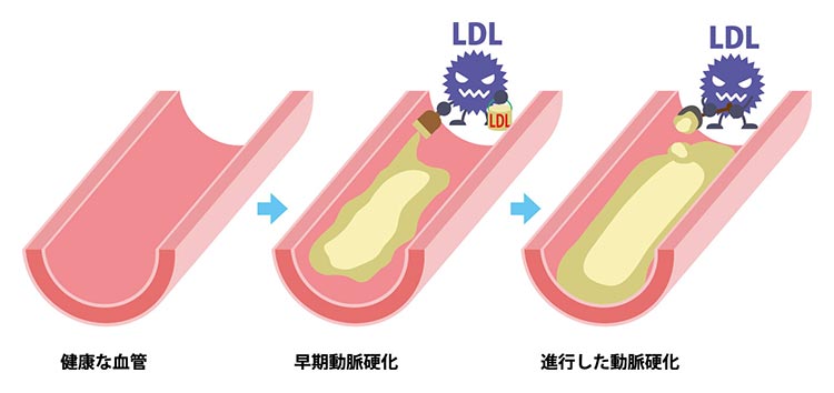 脂質異常症_血管閉塞イメージ