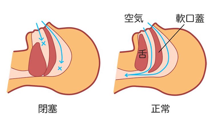 睡眠時無呼吸症候群イメージ