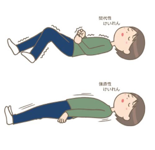てんかんイメージ