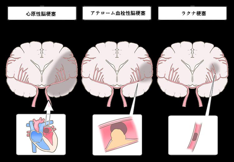 脳梗塞イメージ
