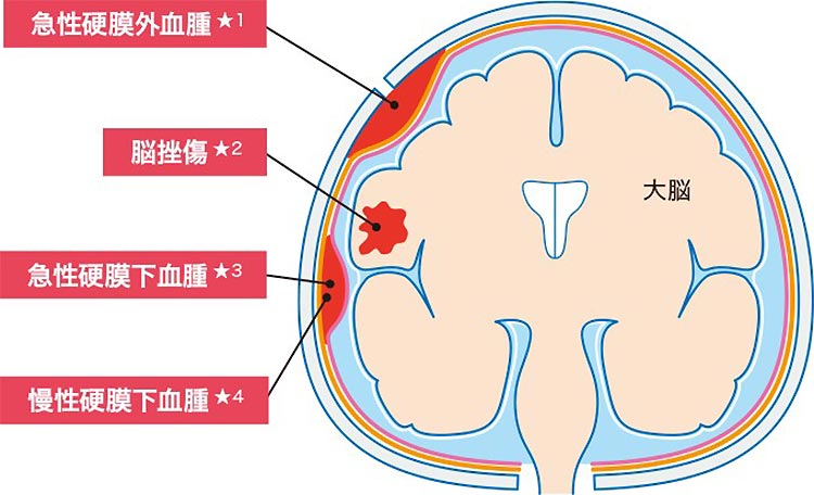 頭部外傷イメージ