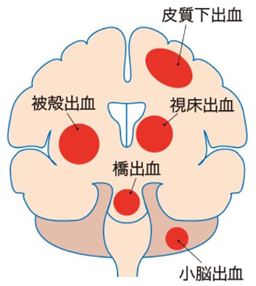 脳出血イメージ