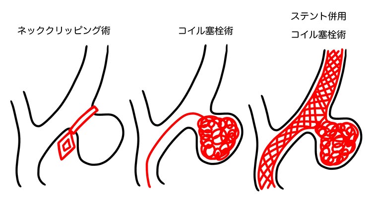 くも膜下出血_脳動脈瘤手術イメージ