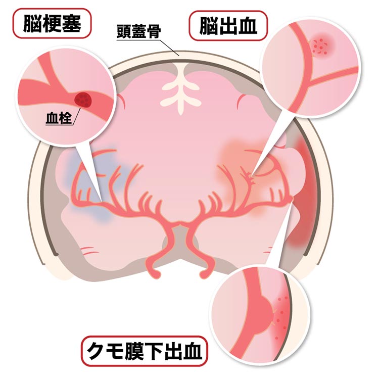脳卒中イメージ