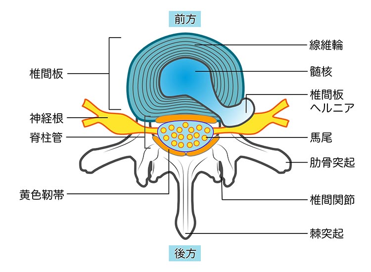 腰椎椎間板ヘルニアイメージ
