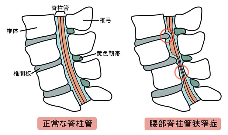 脊柱管狭窄症イメージ